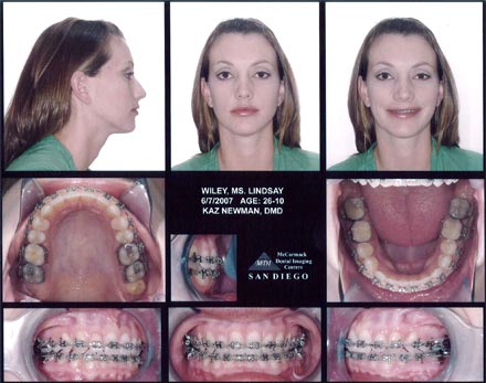 Smile Gallery Patient After