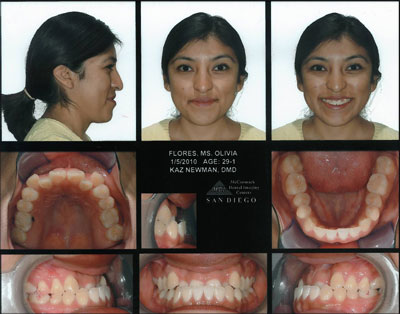 Smile Gallery Patient Before