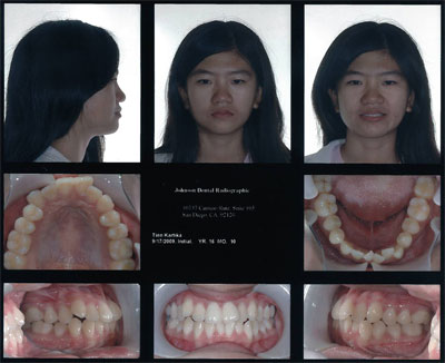 Smile Gallery Patient Before