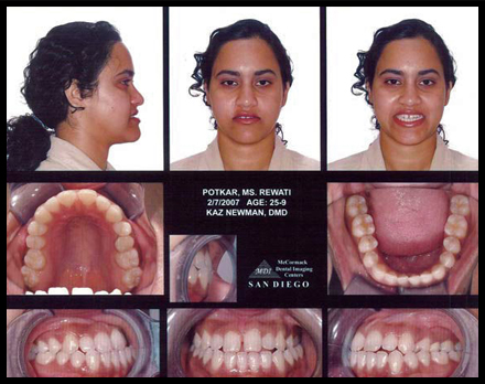 Smile Gallery Patient Before