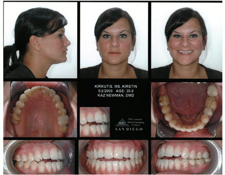 Smile Gallery Patient Before