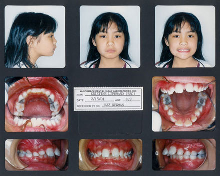 Smile Gallery Patient Before