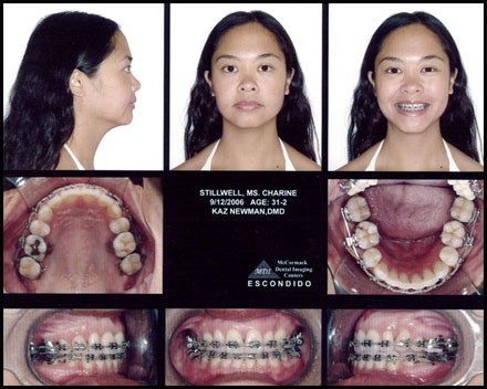 Smile Gallery Patient After