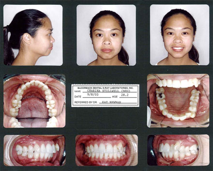 Smile Gallery Patient Before