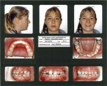 Smile Gallery Patient Before