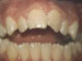 Openbite: Front teeth don't touch