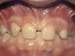 Missing lateral incisors