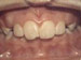 Overbite: Protruding front teeth